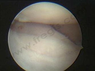 Figure 2: Vision d'une FPC (fragmentation de processus coronoïde) chez un chien