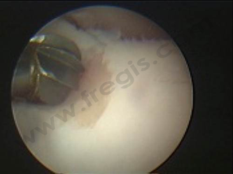 Figure 3: Chirurgie assistée par arthroscopie d'une FPC (fragmentation de processus coronoïde) chez un chien