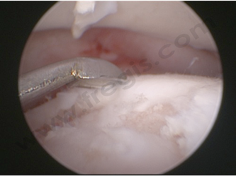 Exemple de prise en charge chirurgicale d'une lésion cartilagineuse par curetage sous arthroscopie
