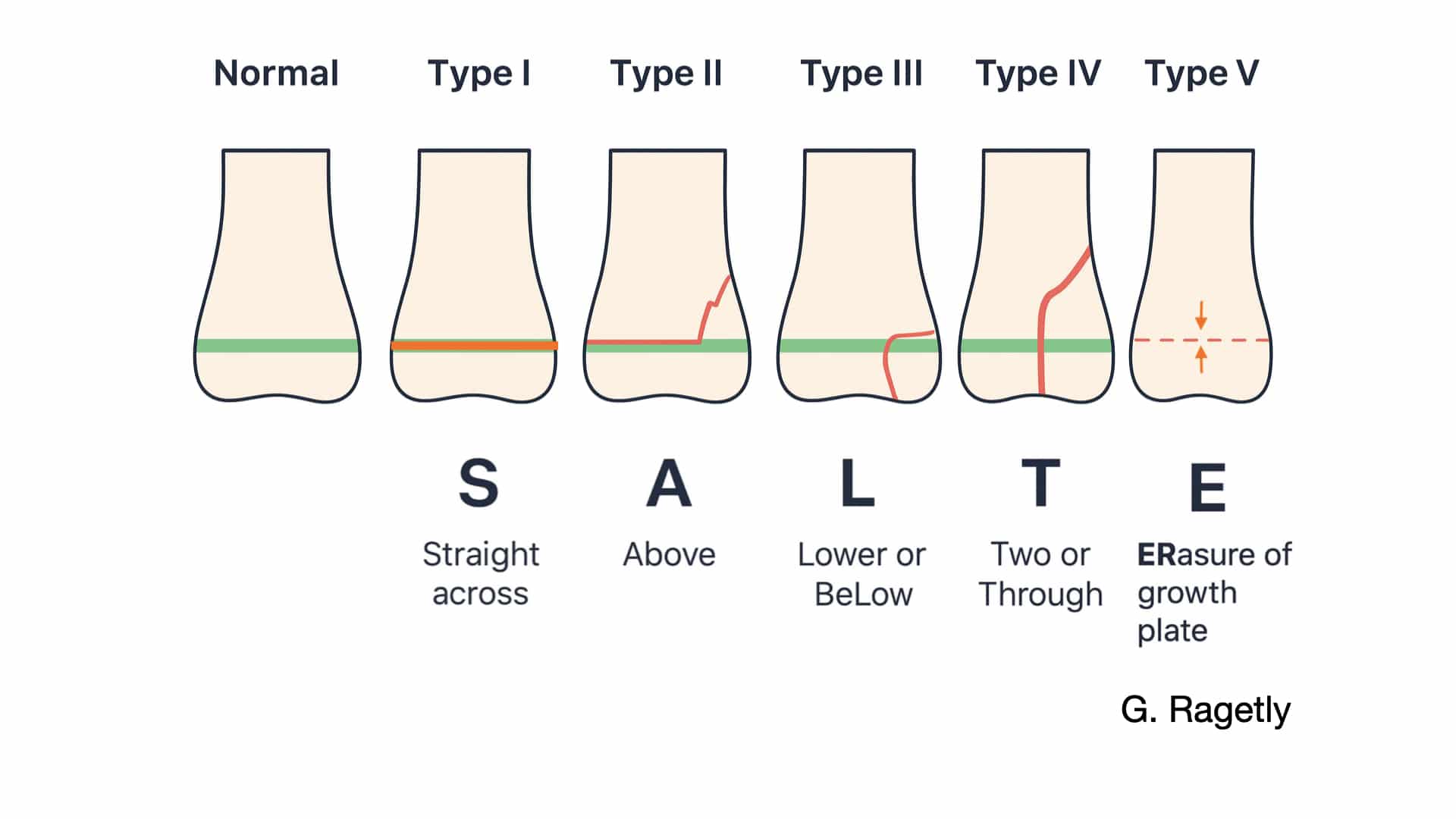 Schéma des différents types de fracture du cartilage de croissance chez le chiot selon la classification de Salter-Harris