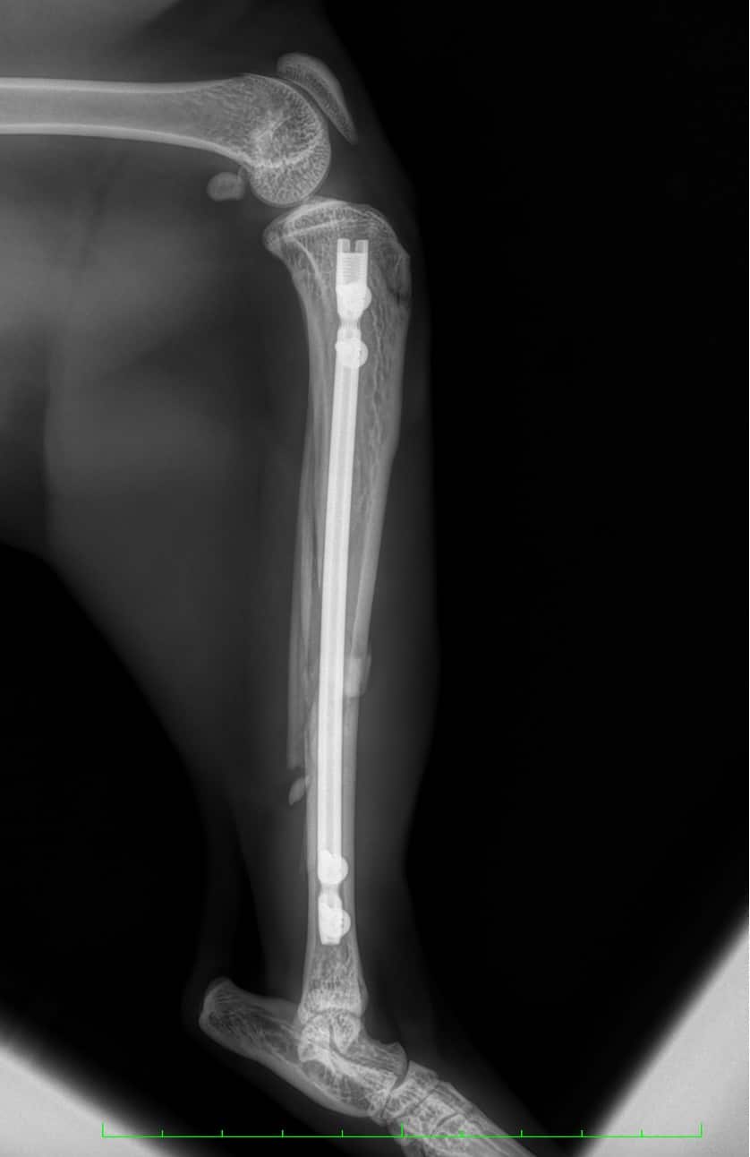 Ostéosytnhèse du tibia par clou verrouillé