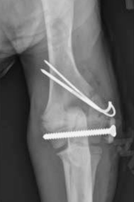 Vue post-opératoire montrant une bonne réduction, avec une stabilisation optimale