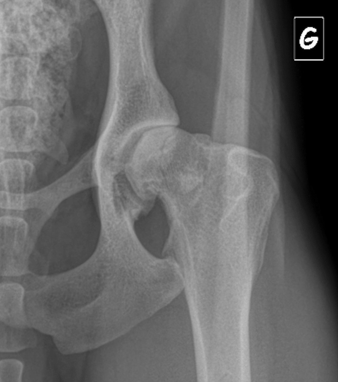 Radiographie des hanches d'un jeune chien dysplasique. Les têtes fémorales ne sont pas assez couvertes par les cavités du bassin destinées à les recevoir (subluxation).