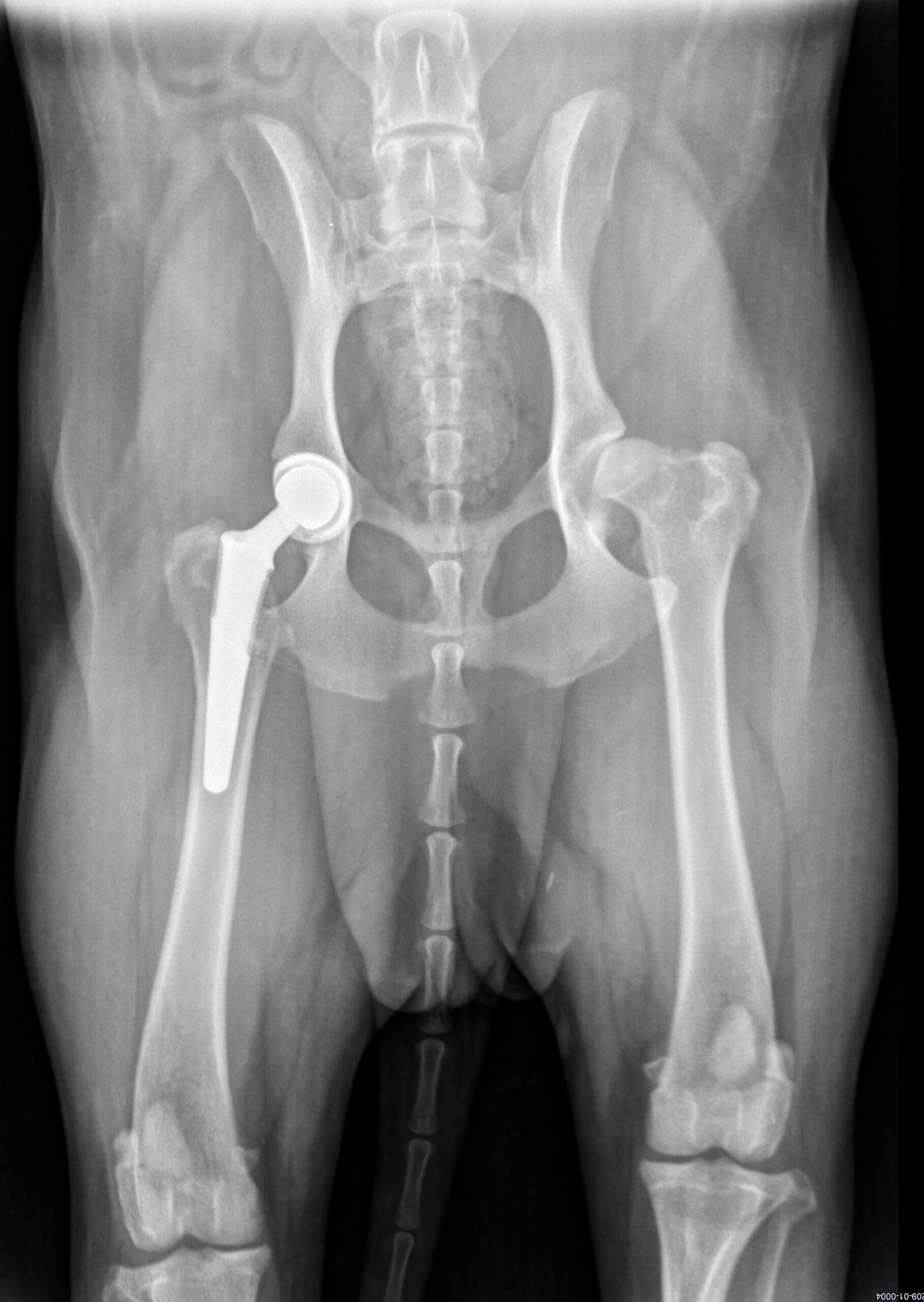 Radiographie postopératoire d’une prothèse de hanche.