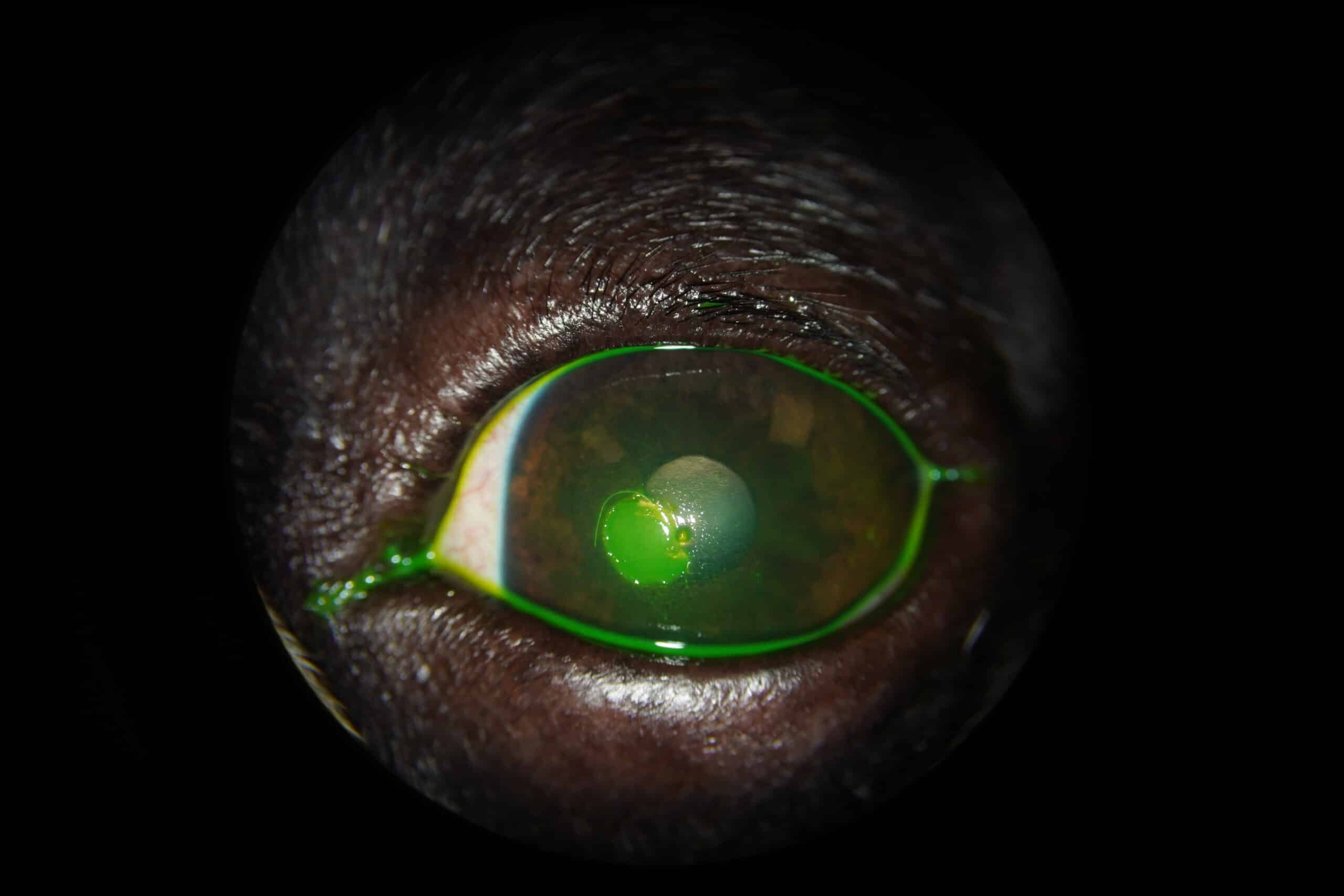 Ulcère cornéen à bords décollés (indolent) chez un Bouledogue français de 7 ans. L’ulcère cornéen superficiel est localisé en regard de la plage qui retient le colorant vert (fluorescéine). 