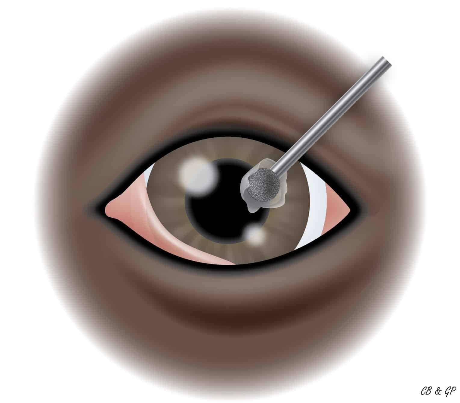 Traitement chirurgical d’un ulcère cornéen à bords décollés. La fraise (Diamond burr, grip médian, diamètre de 3.5 mm) est appliquée sur la cornée en regard du site de l’ulcère et autour de celui-ci. La fraise va permettre de retirer la couche superficielle de la cornée (épithélium) partout où elle est décollée du reste de la cornée. Cette procédure peut être effectuée sous anesthésie locale ou sous anesthésie générale en fonction des cas.  